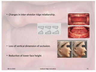 660365804-Residual-ridge-resorption-seminar-PART-2.pptx