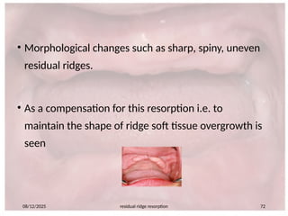 Sharp Spiny Ridge 660365804-Residual-ridge-resorption-seminar-PART-2.pptx