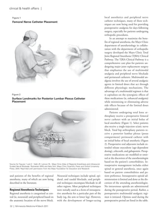 Figure 1
Femoral Nerve Catheter Placement
Figure	2
Surface Landmarks for Posterior Lumbar Plexus Catheter
Placement
and patients of the benefits of regional
anesthesia, many of which are now being
described in the literature.
Regional Anesthesia Techniques
Regional anesthesia is categorized as cen-
tral (ie, neuraxial) and peripheral based on
the anatomic location of the nerve block.
Neuraxial techniques include spinal, epi-
dural, and caudal blockade, and periph-
eral techniques encompass blockade in all
other regions. Most peripheral techniques
were initially used as a form of intraopera-
tive anesthesia for a particular part of the
body (eg, the arm or lower leg). However,
with the development of longer-acting
local anesthetics and peripheral nerve
catheter techniques, many of these tech-
niques are now being used for providing
postoperative analgesia for days following
surgery, especially for patients undergoing
orthopedic procedures.
In an attempt to maximize the bene-
fits of regional anesthesia, the Mayo Clinic
department of anesthesiology in collabo-
ration with the department of orthopedic
surgery developed the Mayo Clinic Total
Joint Regional Anesthesia (TJRA) Clinical
Pathway. The TJRA Clinical Pathway is a
comprehensive care plan for patients un-
dergoing major joint replacement surgery
that emphasizes the use of multimodal
analgesia and peripheral nerve blockade
and perineural catheters. Multimodal an-
algesia involves the use of several analgesic
agents in limited doses that act through
different physiologic mechanisms. The
advantage of a multimodal regimen is that
it capitalizes on the synergistic effects of
these medications (ie, enhanced analgesia)
while minimizing or eliminating adverse
side effects because of the limited doses
administered.
Patients undergoing total knee ar-
throplasty receive a preoperative femoral
nerve catheter with an initial bolus of
local anesthetic (Figure 1). Select patients
also receive a single-injection sciatic nerve
block. Total hip arthroplasty patients re-
ceive a posterior lumbar plexus (psoas
compartment) perineural catheter with
an initial bolus of local anesthetic (Figure
2). Preoperative oral adjuvants include ex-
tended release oxycodone (age-dependent
dosing), celecoxib, and gabapentin. Preop-
erative medications are modified or omit-
ted at the discretion of the anesthesiologist
based on the patient’s comorbidities. In-
traoperative management includes either
spinal or general anesthesia, once again
based on patient comorbidities and pa-
tient preference. Intraoperative opioid ad-
ministration is limited and done at the dis-
cretion of the attending anesthesiologist.
No intravenous opioids are administered
during the postoperative period. Rather, a
postoperative multimodal analgesic regi-
men is initiated. Options used during the
postoperative period are listed in the table.
source for figures 1 and 2: Hebl Jr, lennon rl. Mayo Clinic atlas of regional anesthesia and Ultrasound-
Guided nerve Blockade. rochester (Mn) and new York: Mayo Clinic scientific Press and Oxford University
Press; 2010. reprinted with permission from the Mayo foundation for education and research.
32 | Minnesota Medicine • March 2011
clinical & health affairs |
 