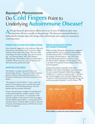 Raynaud’s Phenomenon
Do Cold Fingers Point to
Underlying Autoimmune Disease?
Numbness and Tri-phased Color Change in Fingers
Most frequently triggered by cold conditions, Raynaud’s
phenomenon causes blood vessels to constrict. Digits
undergo a three-staged color change “that starts with
white fingers that next turn blue, then red on rewarm-
ing,” says Norman Ilowite, MD, chief, Pediatric
Rheumatology, The Children’s Hospital at Montefiore
(CHAM). Patients’ feet, ears, nose and lips may also
chill and become painful and numb.
Identifying At-risk Patients
The disorder is strongly associated with several
rheumatologic diseases – 95 percent of all scleroderma
patients experience Raynaud’s phenomenon, as do
85 percent of all patients with mixed connective tissue
disease.
“The question,” says Dr. Ilowite, “is how to pick the
patients who are going to have secondary Raynaud’s
phenomenon,” with underlying disease, “from the
patients who have primary Raynaud’s.”
Patients who persistently complain of cold, blanched
or blue hands should be carefully evaluated. “Most
important,” says Dr. Ilowite, “is examination of the
nail bed capillaries.” Red striations in this area suggest
nail bed capillary abnormalities – a strong indicator of
secondary disease. Morning stiffness in joints, shortness
of breath and serological presence of ANA also warrant
further investigation.
Pediatric Rheumatologists Provide
Best Diagnostic Reassurance
When secondary Raynaud’s phenomenon is suggested,
patients should be seen by a pediatric rheumatologic
specialist when possible. CHAM is fortunate to have
two pediatric rheumatologists – only 229 of these
sub-specialized experts practice in the U.S. today –
Dr. Ilowite and his colleague, Patricia Irigoyen, MD,
at the helm of its pediatric rheumatologic clinical and
research programs.
Supported by pediatric specialists in all related
disciplines, Drs. Ilowite and Irigoyen expertly manage
the most complex Raynaud’s-related rheumatologic
conditions or – to parents’ enormous relief – rule them
out. Because happily, at the end of the diagnostic day,
“95 percent of kids with primary Raynaud’s disease will
not have secondary Raynaud’s,” says Dr. Ilowite.
Nail bed capillaries in a patient with secondary Raynaud’s phenomemom
Normal
Dilated and
Tortuous
Drop out
Tortuous Drop out
13
Although Raynaud’s phenomenon affects almost one in every 20 adolescent girls, many
pediatricians will never actually see the pathology. This rheumatic-associated disorder is
hallmarked by dramatic digit color changes that, unfortunately, don’t appear on command in
examining rooms.
 