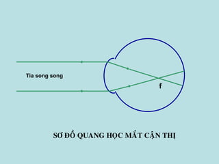 SÔ ÑOÀ QUANG HOÏC MAÉT CAÄN THÒ
f
Tia song song
 