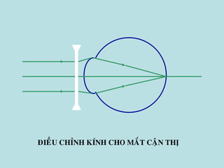 ÑIEÀU CHÆNH KÍNH CHO MAÉT CAÄN THÒ
 