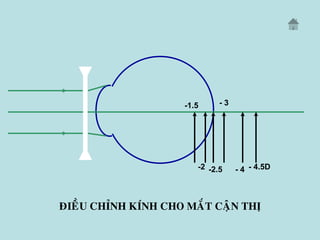 ÑIEÀU CHÆNH KÍNH CHO MAÉT CAÄN THÒ
- 4.5D- 4
- 3
-2.5-2
-1.5
 