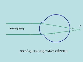SÔ ÑOÀ QUANG HOÏC MAÉT VIEÃN THÒ
f
Tia song song
 