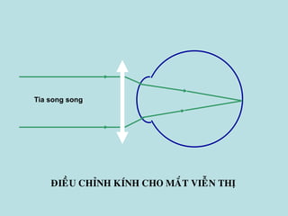 ÑIEÀU CHÆNH KÍNH CHO MAÉT VIEÃN THÒ
Tia song song
 