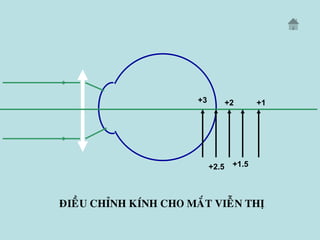 ÑIEÀU CHÆNH KÍNH CHO MAÉT VIEÃN THÒ
+2.5
+3 +2
+1.5
+1
 