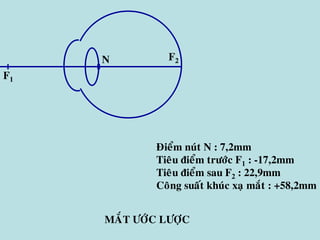 N
F1
F2
MAÉT ÖÔÙC LÖÔÏC
Ñieåm nuùt N : 7,2mm
Tieâu ñieåm tröôùc F1 : -17,2mm
Tieâu ñieåm sau F2 : 22,9mm
Coâng suaát khuùc xaï maét : +58,2mm
 