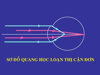 SÔ ÑOÀ QUANG HOÏC LOAÏN THÒ CAÄN ÑÔN
 
