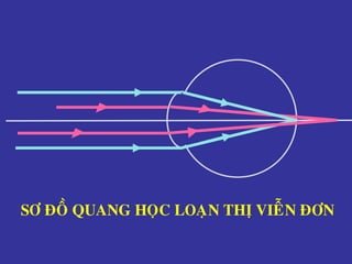 SÔ ÑOÀ QUANG HOÏC LOAÏN THÒ VIEÃN ÑÔN
 