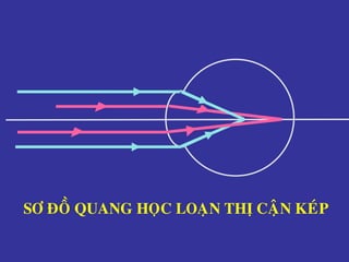 SÔ ÑOÀ QUANG HOÏC LOAÏN THÒ CAÄN KEÙP
 