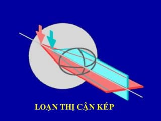 LOAÏN THÒ CAÄN KEÙP
 