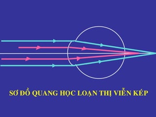 SÔ ÑOÀ QUANG HOÏC LOAÏN THÒ VIEÃN KEÙP
 
