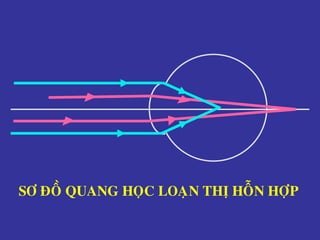 SÔ ÑOÀ QUANG HOÏC LOAÏN THÒ HOÃN HÔÏP
 