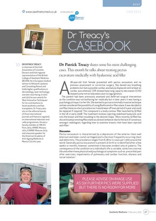 B O D Y
67Aesthetic Medicine • February 2015
SPONSORED BY CASE FILESwww.aestheticmed.co.uk
Dr Patrick Treacy shares some his most challenging
cases. This month he talks about treating pectus
excavatum medically with hyaluronic acid filler
Dr Treacy’s
CASEBOOK
DR PATRICK TREACY
is chairman of the Irish
Association of Cosmetic
Doctors and Irish regional
representative of the British
College of Aesthetic Medicine
(BCAM). He is European medical
advisor to Network Lipolysis
and Consulting Rooms and
holds higher qualifications in
dermatology, laser technology
and skin resurfacing. In 2012
and 2013 he won awards for
‘Best Innovative Techniques’
for his contributions to
facial aesthetics and hair
transplants. Dr Treacy also
sits on the editorial boards
of three international
journals and features regularly
on international television and
radio programmes. He was a
faculty member at IMCAS
Paris 2013, AMWC Monaco
2013, EAMWC Moscow 2013
and a keynote speaker for
the American Academy of
Anti-Ageing Medicine in
Mexico City this year.
>>
A
28-year-old Irish female presented with pectus excavatum and no
previous assessment or corrective surgery. She denied any breathing
problems but had a possible cardiac anomaly (a displaced central beat on
cardiac auscultation). CXR showed base lung capacity decreased. ECHO
showed some mitral redundancy but no regurgitation.
The patient had been previously assessed and deferred surgical intervention
as the condition was not bothering her medically but in later years it was having a
psychologicalimpactonherlife.Shewantedtopursueaminimallyinvasivetechnique
andweconsideredthepossibilityofusingBioAlcamidorMacrolane.Itwasdecidedto
use Macrolane as a test procedure as it would wear off over period of a year and could
be replaced if required. This compound is a body-contour filler launched by Q-Med
in the UK in early 2008. The treatment involves injecting stabilised hyaluronic acid
into the breast and then moulding to the desired shape. More recently, Q-Med has
discontinuedpromotingMacrolaneasabreastenhancerduetothelackofconsensus
amongst radiologists regarding how to examine breasts that have been injected
with filler.1
Discussion
Pectus excavatum is characterised by a depression of the anterior chest wall
(sternum and lower costal cartilages) and is the most frequently occurring chest
wall deformity. The prevalence ranges from 6.28 to 12 cases per 1,000 around the
world. Generally pectus excavatum is present at birth or is identified after a few
weeks or months; however, sometimes it becomes evident only at puberty. The
consequence of the condition on a individual’s life is variable, some live a normal
life and others have physical and psychological symptoms such as: precordial pain
after exercises; impairments of pulmonary and cardiac function; shyness and
social isolation.2
PLEASE ADVISE ON IMAGE USE
AS SIX FURTHER PICS WERE SUPPLIED
BUT THERE IS NO ROOM FOR MORE
 