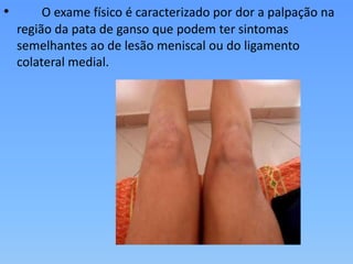 • O exame físico é caracterizado por dor a palpação na
região da pata de ganso que podem ter sintomas
semelhantes ao de lesão meniscal ou do ligamento
colateral medial.
 