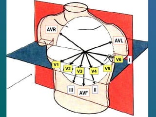 AVR
AVL
AVF
I
IIIII
V1
V2
V3 V4
V5
V6
 