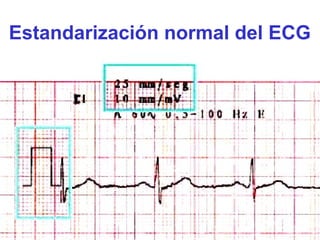 Estandarización normal del ECG
 