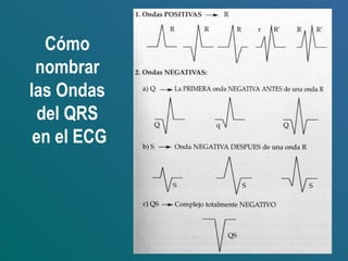 Cómo
nombrar
las Ondas
del QRS
en el ECG
 