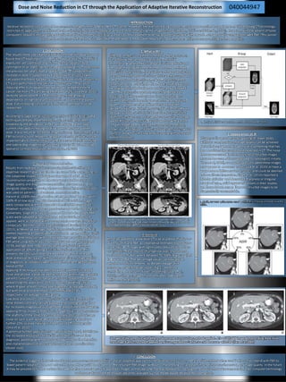INTRODUCTION
Iterative reconstruction was used to reconstruct images in Hounsfield’s first CT scanner. However, the ever increasing computational power required to apply IR to rapidly evolving CT technology,
restricted its application, and filtered back projection (FBP) was accepted as a means of reconstructing the images instead (Beister, Kolditz and Kalender, 2012). However, with the advent of faster
computers, research into applying Adaptive Iterative Reconstruction (IR) as a means to reduce patient dose has proved favourable with regards to image quality comparisons with FBP. This poster
discusses the advances of IR and how its applications have led to a measurable reduction in patient dose, while not compromising on image quality.
1. DISCUSSION
The results of the 2003 National Radiation Protection Board survey
found that CT examinations in the UK make up only 9% of medical
exposures, yet contribute to 47% of the total radiation dose
(Shrimpton et al, 2005), demonstrating a doubling in CT doses from
the previous ten years (Hart and Wall, 2004). This exponential
increase in dose is supported by Karpitschka et al, (2013) who
calculated that there has been a 12-fold increase in the amount of
CT scans performed in the UK in the last 25 years. The cancer
inducing effects of radiation are well known with the lifetime
cancer risk from CT scans being estimated at 2% (Silva et al, 2010).
With the advancement in CT technology and the growing
dependence on high dose procedures, it is apparent that patient
dose is of increasing concern, and reduction methods must be
researched.
According to Sagara et al, (2010), currently available dose-saving
techniques already implemented into CT scanning has been
hindered by the limitations of FBP. Whilst lowering the tube
current (mA) and increasing rotation speed decreases patient
dose; it also results in increased image noise and inconsistencies in
FBP reconstructions. Modern computer technology allows for the
implementation of IR techniques which are capable of identifying
and subtracting image noise (Silva et al, 2010) without reducing
spatial or contrast resolution (Mitsumori et al, 2012).
Dose and Noise Reduction in CT through the Application of Adaptive Iterative Reconstruction
3. Appearances of IR
It is generally agreed that by applying IR, lower doses
without a compromise on image quality can be achieved.
Nevertheless; inherent image noise is something that has
been traditionally accepted and expected in CT. The noise
free appearance of the iteratively reconstructed images
may not be acceptable or appealing to radiologists initially
(Hara et al, 2009), as reports have concluded these images
may appear to be over-smooth (Silva et al, 2010) or have a
waxy texture (Mitsumori et al, 2012); and could be deemed
to be artifacts themselves. Singh et al, (2010) reported a
blotchy pixilation and decreased sharpness or irregular
margin of cysts, solid organs and vessels in their studies;
yet these did not render the reconstructed images to be
diagnostically unacceptable.
2. What is IR?
Different vendors use different methods of IR processes,
but all follow the same basic principle. The initial
information from the FBP is used as a ‘building block’ and
the value of each pixel is transformed to a new estimated
value (Silva et al, 2010). These pixels are forward projected
to produce estimated projections which are then compared
to the measured values (Karpitschka et al, 2013). After a
correction factor is obtained, this is back-projected across
the original estimated values to produce new estimated
vales. The process is repeated, correcting the data by
reducing the difference between the two projections
(Hsieh, 2009), until the estimates match these measured
values , or a fixed number of iterations are reached
(Beister, Kolditz and Kalender, 2012). (Fig. 1) This software
is known as Adaptive Statistical Iterative Reconstruction
(ASIR) on GE scanners, and Image Reconstruction in Image
Space (IRIS) on Siemens. GE has followed on with a more
complex model based iterative reconstruction method,
known as ‘VEO’ (Beister, Kolditz and Kalender, 2012), which
claims to allow for ‘ultra low dose’ scanning with increased
spatial resolution.
4. Blending
IR can be applied to a low dose CT scan as a linear mixture or
a ‘blend’ of IR and FBP; a compromise intended to produce a
more typical CT image with significantly reduced dose (Hara
et al, 2009). These reports of unfamiliar over-smoothening
are based on studies where between 70-100% IR was applied
to low dose FBP. The percentage values can typically be
adjusted in 10% increments: as the percentage of IR
increases, image noise decreases (Fig.2), therefore
controlling the amount of over-smoothing (Silva, et al.,
2010), resulting in images more familiar to radiologists
(Mitsumori et al, 2012).
5. Noise and Dose Reduction
Results from multiple studies comparing both subjective and
objective research give promise for the use of IR in dose saving. In
the subjective studies, radiologists who were blinded to the
reconstruction properties of the scan were asked to score on
image quality and diagnostic acceptability. This was performed
alongside objective research, where a region of interest (ROI) tool
was used on patients or phantoms to measure noise.
Hara et al, (2009) measured noise as being reduced by 75% with
100% IR on low dose CT, with dose halved with 50% IR. Images
were comparable with full dose FBP when 30% IR was applied.
However it produced an average reduction of 44% in dose (Fig 3.).
Conversely, Singh et al, (2010) reported that low dose 100% FBP
scans were suboptimal, whilst those that had 30% and 50% IR
applied, were acceptable with no compromise on vessel or lesion
conspicuity. Both Mitsumori et al, (2012) and Karpitschka et al,
(2013), achieved an average of 40% dose reduction using 50% IR;
neither reporting an appreciable reduction in image quality. A 28%
average dose reduction with comparable image quality to full dose
FBP while using 40% IR was reported by Sagara et al, (2010) and
31.5% average dose reduction by Desai et al, (2012) with the
application of 30% IR, giving a 33.3% reduction in noise. This
presents the conclusion that as the percentage of IR increases,
dose and noise decreases, without compromise on image quality
or diagnostic acceptability when used with the best agreed upon
blend of FBP.
Applying IR techniques has been shown to lower the increased
noise and photon starvation artefact created when imaging obese
patients (Silva et al, 2010). Desai et al, (2012) supports this when
researching the application of IR on patients weighing ≥91 kg
where IR gave at least comparable diagnostic acceptability to FBP,
but with noise and dose reductions of 50% and 21.4%,
respectively, on average for this group.
Low dose procedures currently in clinical use, such as those for
renal stones, coronary calcium plaques and colonography, allow
for increased image noise outside of the area of interest. However,
applying IR has shown a reduction in image noise can demonstrate
the anatomy of the solid organs traditionally obscured by image
noise on such scans, while also potentially lowering dose by a
further 25%, or even halving it in the case of CT colonography
(Silva et al, 2010).
A potential further application suggested by Hara et al, (2009) was
the increased resolution of typically noisy thin slices and their
diagnostic potential when reconstructed with IR for the detection
and characterisation of lesions which may have been missed on
thicker slices.
6. CONCLUSION
The evidence suggests that with an advancement in computer capabilities and an adaptive approach to iterative reconstruction, IR is a feasible method when used in the correct blend with FBP to
lower patient radiation dose and reduce the noise that would be incident on the resultant FBP image, without compromising on, and even in some instances improving, on image quality. In the future
it may be possible to further reduce dose with higher percentages of IR applied to images as they become more acceptable to radiologists, and as further advancements in faster computer technology
and more advanced IR techniques becomes available such as Model Based Iterative Reconstruction.
Fig 1. Schematic of the IR process (Beister, Kolditz and Kalender, 2012).
Example of low dose images which were reconstructed with FBP (A&C) showing noisy
images compared against the same images reconstructed with IR (B&D) demonstrating
a smoother appearance (Beister, Kolditz and Kalender, 2012.
Fig 2. Diagram showing the appearances of applying IR in increasing increments (Silva et al,
2010) .
040044947
3 images of the same slice with different doses and reconstruction methods applied. A is a 100% FBP image demonstrating more noise
than image B which has had IR applied, and is comparable to C which is a full dose scan with FBP (Hara et al, 2009)
 