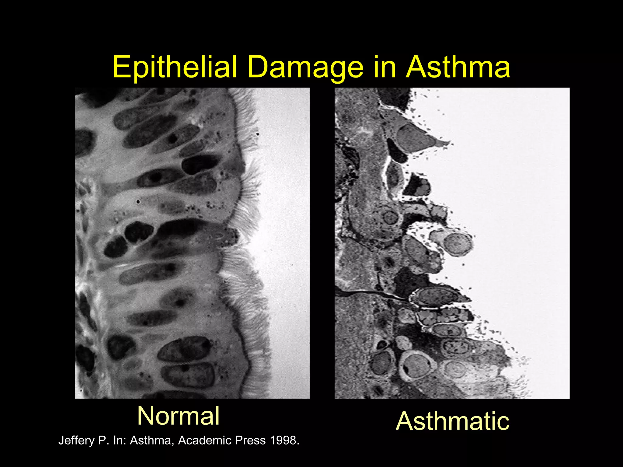 AsthmaticNormal
Jeffery P. In: Asthma, Academic Press 1998.
Epithelial Damage in Asthma
 