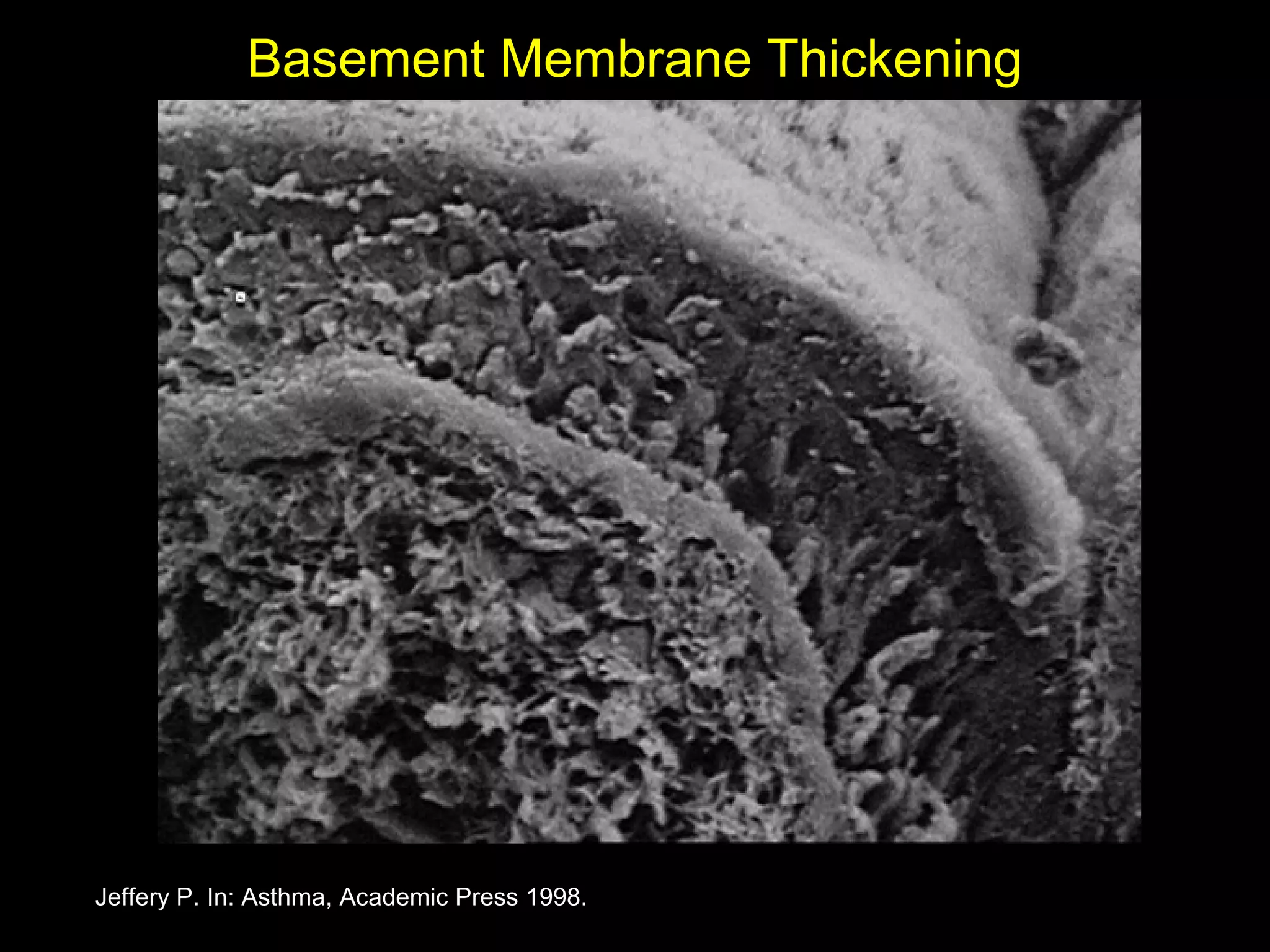 Basement Membrane Thickening
Jeffery P. In: Asthma, Academic Press 1998.
 