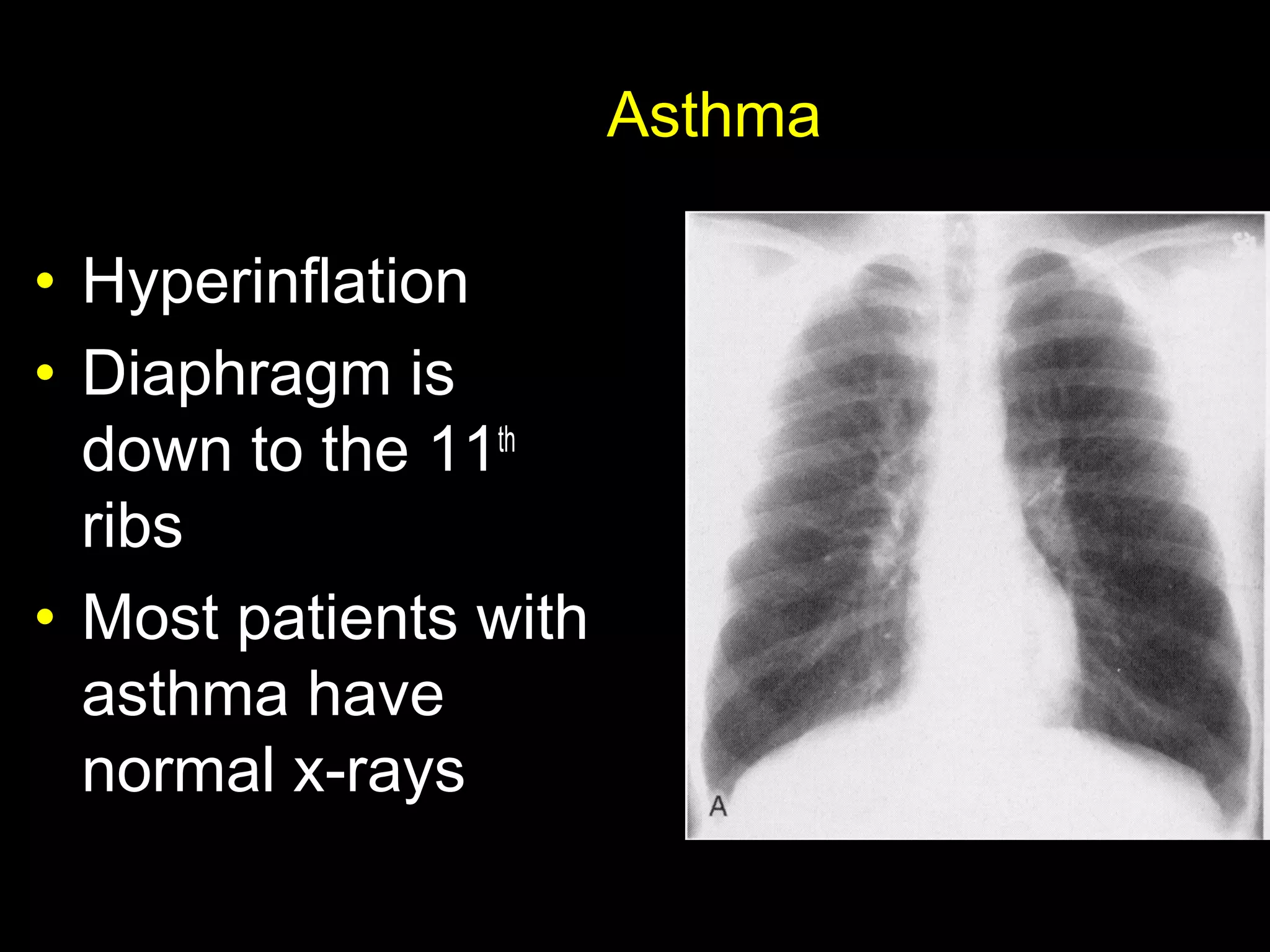 Asthma
• Hyperinflation
• Diaphragm is
down to the 11th
ribs
• Most patients with
asthma have
normal x-rays
 