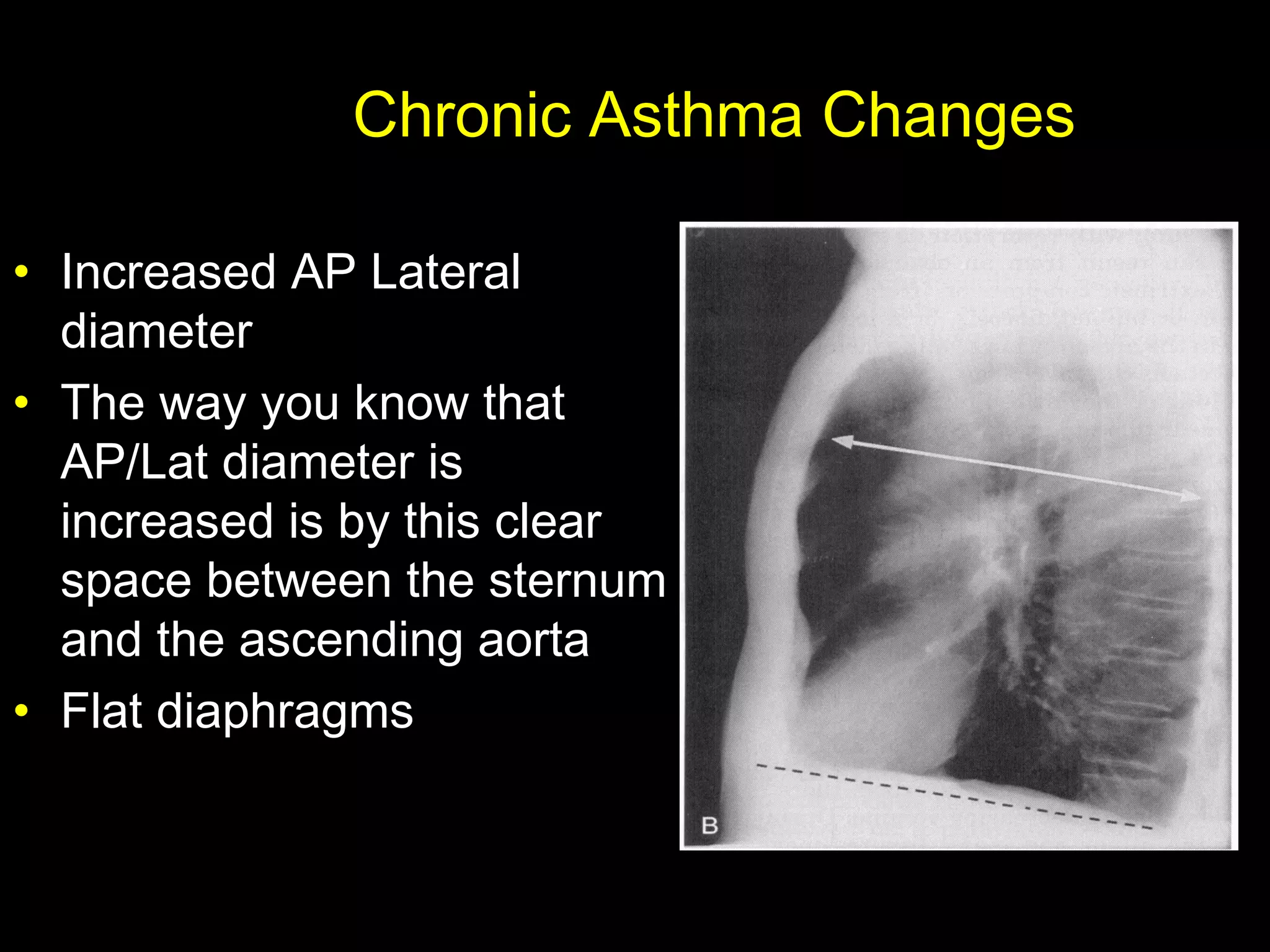 Chronic Asthma Changes
• Increased AP Lateral
diameter
• The way you know that
AP/Lat diameter is
increased is by this clear
space between the sternum
and the ascending aorta
• Flat diaphragms
 