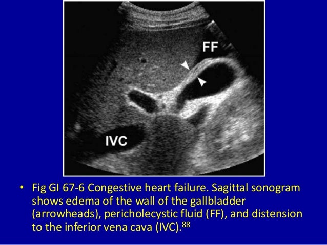 67 thickened gallbladder wall