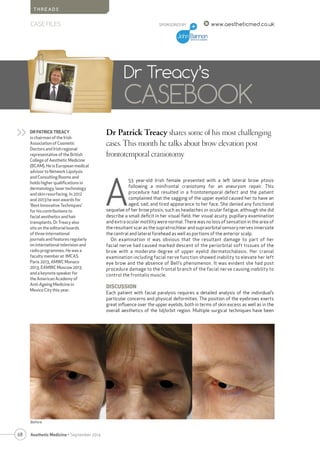 68 Aesthetic Medicine • September 2014
SPONSORED BY www.aestheticmed.co.uk
T H R E A D S
CASE FILES
Dr Patrick Treacy shares some of his most challenging
cases. This month he talks about brow elevation post
frontotemporal craniotomy
Dr Treacy’s
CASEBOOK
DR PATRICK TREACY
is chairman of the Irish
Association of Cosmetic
Doctors and Irish regional
representative of the British
College of Aesthetic Medicine
(BCAM). He is European medical
advisor to Network Lipolysis
and Consulting Rooms and
holds higher qualifications in
dermatology, laser technology
and skin resurfacing. In 2012
and 2013 he won awards for
‘Best Innovative Techniques’
for his contributions to
facial aesthetics and hair
transplants. Dr Treacy also
sits on the editorial boards
of three international
journals and features regularly
on international television and
radio programmes. He was a
faculty member at IMCAS
Paris 2013, AMWC Monaco
2013, EAMWC Moscow 2013
and a keynote speaker for
the American Academy of
Anti-Ageing Medicine in
Mexico City this year.
>>
A
53 year-old Irish female presented with a left lateral brow ptosis
following a minifrontal craniotomy for an aneurysm repair. This
procedure had resulted in a frontotemporal defect and the patient
complained that the sagging of the upper eyelid caused her to have an
aged, sad, and tired appearance to her face. She denied any functional
sequelae of her brow ptosis, such as headaches or ocular fatigue, although she did
describe a small deficit in her visual field. Her visual acuity, pupillary examination
and extra ocular motility were normal. There was no loss of sensation in the area of
the resultant scar as the supratrochlear and supraorbital sensory nerves innervate
the central and lateral forehead as well as portions of the anterior scalp.
On examination it was obvious that the resultant damage to part of her
facial nerve had caused marked descent of the periorbital soft tissues of the
brow with a moderate degree of upper eyelid dermatochalasis. Her cranial
examination including facial nerve function showed inability to elevate her left
eye brow and the absence of Bell’s phenomenon. It was evident she had post
procedure damage to the frontal branch of the facial nerve causing inability to
control the frontalis muscle.
DISCUSSION
Each patient with facial paralysis requires a detailed analysis of the individual’s
particular concerns and physical deformities. The position of the eyebrows exerts
great influence over the upper eyelids, both in terms of skin excess as well as in the
overall aesthetics of the lid/orbit region. Multiple surgical techniques have been
Before
 