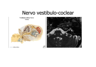 Nervo vestibulo-coclear
vestibulo-

 