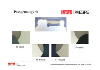 PassgenauigkeitPassgenauigkeit
37 mesial35 distal
35 buccal 37 buccal
Cours Biomatériaux 2006 / Biomatériaux dentaires / J.-M. Meyer / 15.12.2006
 