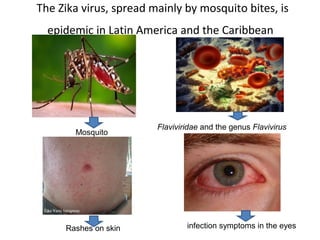 The Zika virus, spread mainly by mosquito bites, is
epidemic in Latin America and the Caribbean
Flaviviridae and the genus Flavivirus
                        Mosquito
infection symptoms in the eyes     Rashes on skin
 