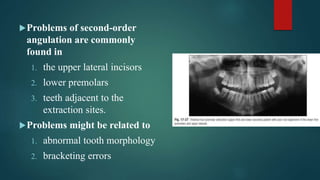 Orthodontic finishing proffit chapter17.pptx