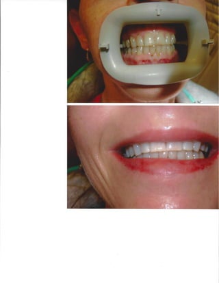 Zoom Whitening Results
