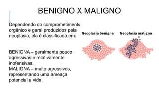 BENIGNO X MALIGNO
Dependendo do comprometimento
orgânico e geral produzidos pela
neoplasia, ela é classificada em:
BENIGNA – geralmente pouco
agressivas e relativamente
inofensivas.
MALIGNA – muito agressivos,
representando uma ameaça
potencial a vida.
 