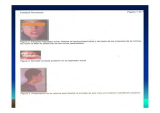 689 371-respiracion bucal present