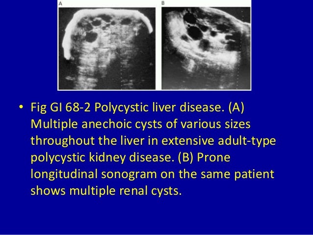 68 focal anechoic (cystic) liver masses