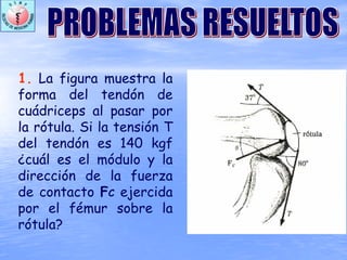 1. La figura muestra la
forma del tendón de
cuádriceps al pasar por
la rótula. Si la tensión T
del tendón es 140 kgf
¿cuál es el módulo y la
dirección de la fuerza
de contacto FC ejercida
por el fémur sobre la
rótula?
 