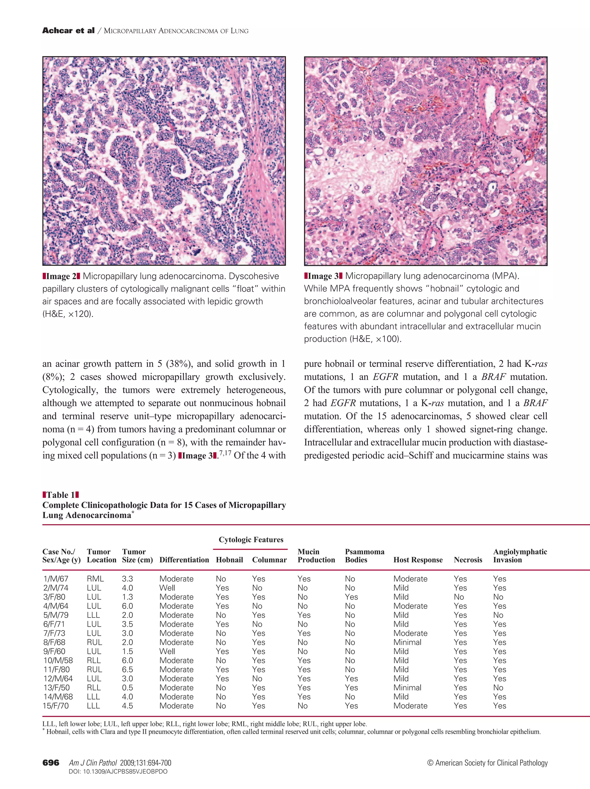 Achcar et al / Micropapillary Adenocarcinoma of Lung




zImage 2z Micropapillary lung adenocarcinoma. Dyscohesive                                       zImage 3z Micropapillary lung adenocarcinoma (MPA).
papillary clusters of cytologically malignant cells “float” within                              While MPA frequently shows “hobnail” cytologic and
air spaces and are focally associated with lepidic growth                                       bronchioloalveolar features, acinar and tubular architectures
(H&E, ×120).                                                                                    are common, as are columnar and polygonal cell cytologic
                                                                                                features with abundant intracellular and extracellular mucin
                                                                                                production (H&E, ×100).

an acinar growth pattern in 5 (38%), and solid growth in 1                                      pure hobnail or terminal reserve differentiation, 2 had K-ras
(8%); 2 cases showed micropapillary growth exclusively.                                         mutations, 1 an EGFR mutation, and 1 a BRAF mutation.
Cytologically, the tumors were extremely heterogeneous,                                         Of the tumors with pure columnar or polygonal cell change,
although we attempted to separate out nonmucinous hobnail                                       2 had EGFR mutations, 1 a K-ras mutation, and 1 a BRAF
and terminal reserve unit–type micropapillary adenocarci-                                       mutation. Of the 15 adenocarcinomas, 5 showed clear cell
noma (n = 4) from tumors having a predominant columnar or                                       differentiation, whereas only 1 showed signet-ring change.
polygonal cell configuration (n = 8), with the remainder hav-                                   Intracellular and extracellular mucin production with diastase-
ing mixed cell populations (n = 3) zImage 3z.7,17 Of the 4 with                                 predigested periodic acid–Schiff and mucicarmine stains was


zTable 1z
Complete Clinicopathologic Data for 15 Cases of Micropapillary
Lung Adenocarcinoma*
	                                                                    	
                                                   Cytologic Features
Case No./	 Tumor	 Tumor				                                                                  Mucin	      Psammoma			                                                 Angiolymphatic	
Sex/Age (y)	 Location	 Size (cm)	 Differentiation	 Hobnail	 Columnar	                        Production	 Bodies	 Host Response	 Necrosis	                            Invasion	

1/M/67   	      RML    	     3.3 	        Moderate     	       No  	        Yes  	           Yes  	            No 	             Moderate       	        Yes  	       Yes  	
2/M/74   	      LUL  	       4.0 	        Well  	              Yes  	       No  	            No  	             No 	             Mild  	                 Yes 	        Yes  	
3/F/80  	       LUL  	       1.3 	        Moderate     	       Yes  	       Yes  	           No  	             Yes 	            Mild  	                 No 	         No  	
4/M/64   	      LUL  	       6.0 	        Moderate     	       Yes  	       No  	            No  	             No 	             Moderate       	        Yes 	        Yes  	
5/M/79   	      LLL  	       2.0 	        Moderate     	       No  	        Yes  	           Yes  	            No 	             Mild  	                 Yes 	        No  	
6/F/71  	       LUL  	       3.5 	        Moderate     	       Yes  	       No  	            No  	             No 	             Mild  	                 Yes 	        Yes  	
7/F/73  	       LUL  	       3.0 	        Moderate     	       No  	        Yes  	           Yes  	            No 	             Moderate       	        Yes 	        Yes  	
8/F/68  	       RUL   	      2.0 	        Moderate     	       No  	        Yes  	           No  	             No 	             Minimal    	            Yes 	        Yes  	
9/F/60  	       LUL  	       1.5 	        Well  	              Yes  	       Yes  	           No  	             No 	             Mild  	                 Yes 	        Yes  	
10/M/58     	   RLL  	       6.0 	        Moderate     	       No  	        Yes  	           Yes  	            No 	             Mild  	                 Yes  	       Yes  	
11/F/80   	     RUL   	      6.5 	        Moderate     	       Yes  	       Yes  	           Yes  	            No 	             Mild  	                 Yes  	       Yes  	
12/M/64     	   LUL  	       3.0 	        Moderate     	       Yes  	       No  	            Yes  	            Yes 	            Mild  	                 Yes 	        Yes  	
13/F/50   	     RLL  	       0.5 	        Moderate     	       No  	        Yes  	           Yes  	            Yes 	            Minimal 	               Yes  	       No  	
14/M/68     	   LLL  	       4.0 	        Moderate     	       No  	        Yes  	           Yes  	            No 	             Mild  	                 Yes 	        Yes  	
15/F/70   	     LLL  	       4.5 	        Moderate     	       No  	        Yes  	           No  	             Yes 	            Moderate       	        Yes 	        Yes  	
LLL, left lower lobe; LUL, left upper lobe; RLL, right lower lobe; RML, right middle lobe; RUL, right upper lobe.
* Hobnail, cells with Clara and type II pneumocyte differentiation, often called terminal reserved unit cells; columnar, columnar or polygonal cells resembling bronchiolar epithelium.




696      Am J Clin Pathol 2009;131:694-700                                                                                                     © American Society for Clinical Pathology
696      DOI: 10.1309/AJCPBS85VJEOBPDO
 
