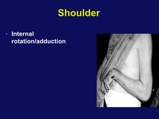 Shoulder
• Internal
rotation/adduction
 