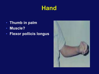 Hand
• Thumb in palm
• Muscle?
• Flexor pollicis longus
 