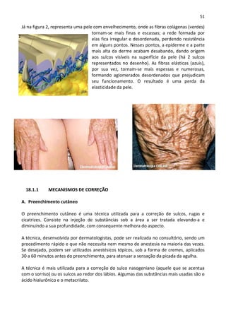51

Já na figura 2, representa uma pele com envelhecimento, onde as fibras colágenas (verdes)
                                   tornam-se mais finas e escassas; a rede formada por
                                   elas fica irregular e desordenada, perdendo resistência
                                   em alguns pontos. Nesses pontos, a epiderme e a parte
                                   mais alta da derme acabam desabando, dando origem
                                   aos sulcos visíveis na superfície da pele (há 2 sulcos
                                   representados no desenho). As fibras elásticas (azuis),
                                   por sua vez, tornam-se mais espessas e numerosas,
                                   formando aglomerados desordenados que prejudicam
                                   seu funcionamento. O resultado é uma perda da
                                   elasticidade da pele.




  18.1.1     MECANISMOS DE CORREÇÃO

A. Preenchimento cutâneo

O preenchimento cutâneo é uma técnica utilizada para a correção de sulcos, rugas e
cicatrizes. Consiste na injeção de substâncias sob a área a ser tratada elevando-a e
diminuindo a sua profundidade, com consequente melhora do aspecto.

A técnica, desenvolvida por dermatologistas, pode ser realizada no consultório, sendo um
procedimento rápido e que não necessita nem mesmo de anestesia na maioria das vezes.
Se desejado, podem ser utilizados anestésicos tópicos, sob a forma de cremes, aplicados
30 a 60 minutos antes do preenchimento, para atenuar a sensação da picada da agulha.

A técnica é mais utilizada para a correção do sulco nasogeniano (aquele que se acentua
com o sorriso) ou os sulcos ao redor dos lábios. Algumas das substâncias mais usadas são o
ácido hialurônico e o metacrilato.
 