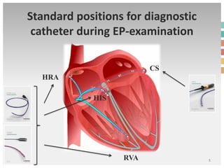 Standard positions for diagnostic
catheter during EP-examination
5
HRA
HIS
RVA
CS
 