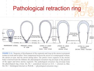 Pathological retraction ring 