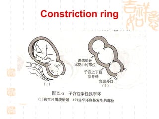 Constriction ring 