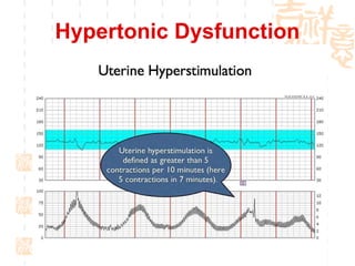 Hypertonic Dysfunction 