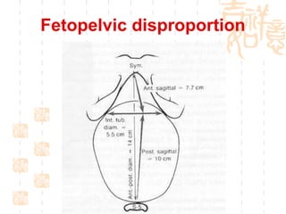 Fetopelvic disproportion 