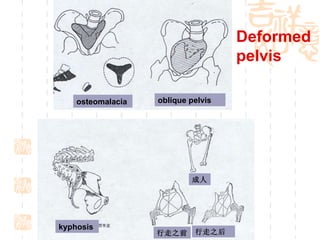 osteomalacia   oblique pelvis   kyphosis   成人 行走之前 行走之后 Deformed pelvis 