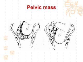 Pelvic mass 