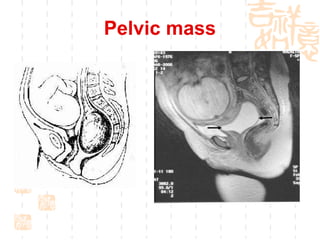 Pelvic mass 
